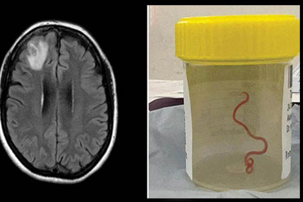 அவுஸ்திரேலிய பெண்ணின் மூளையில் உயிருடன் இருந்த புழு! அதிர்ச்சியில் வைத்தியர்கள்